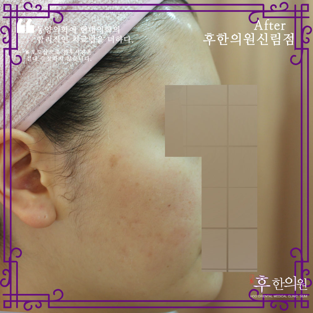 치료 후