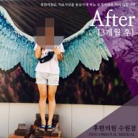 치료 후