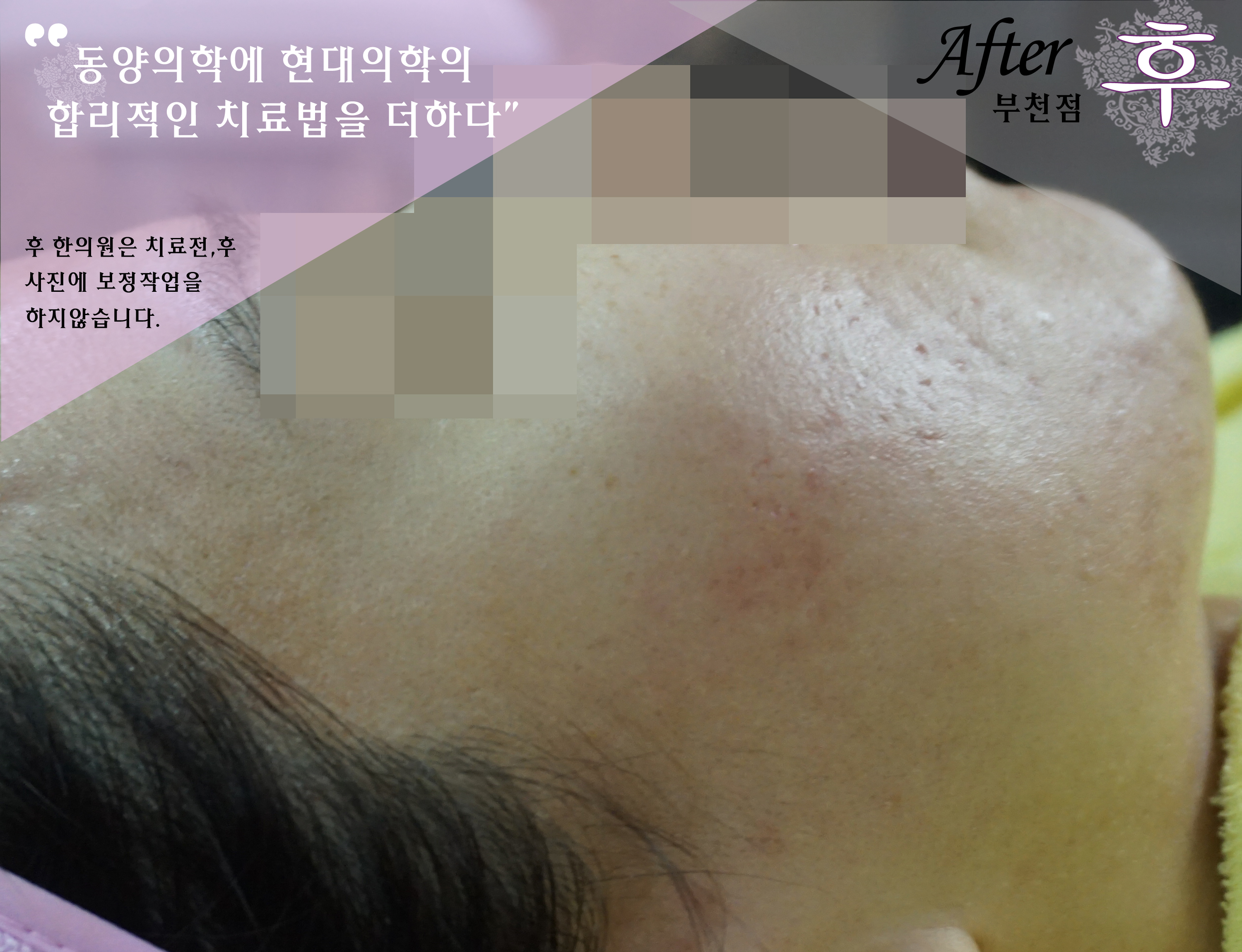치료 후