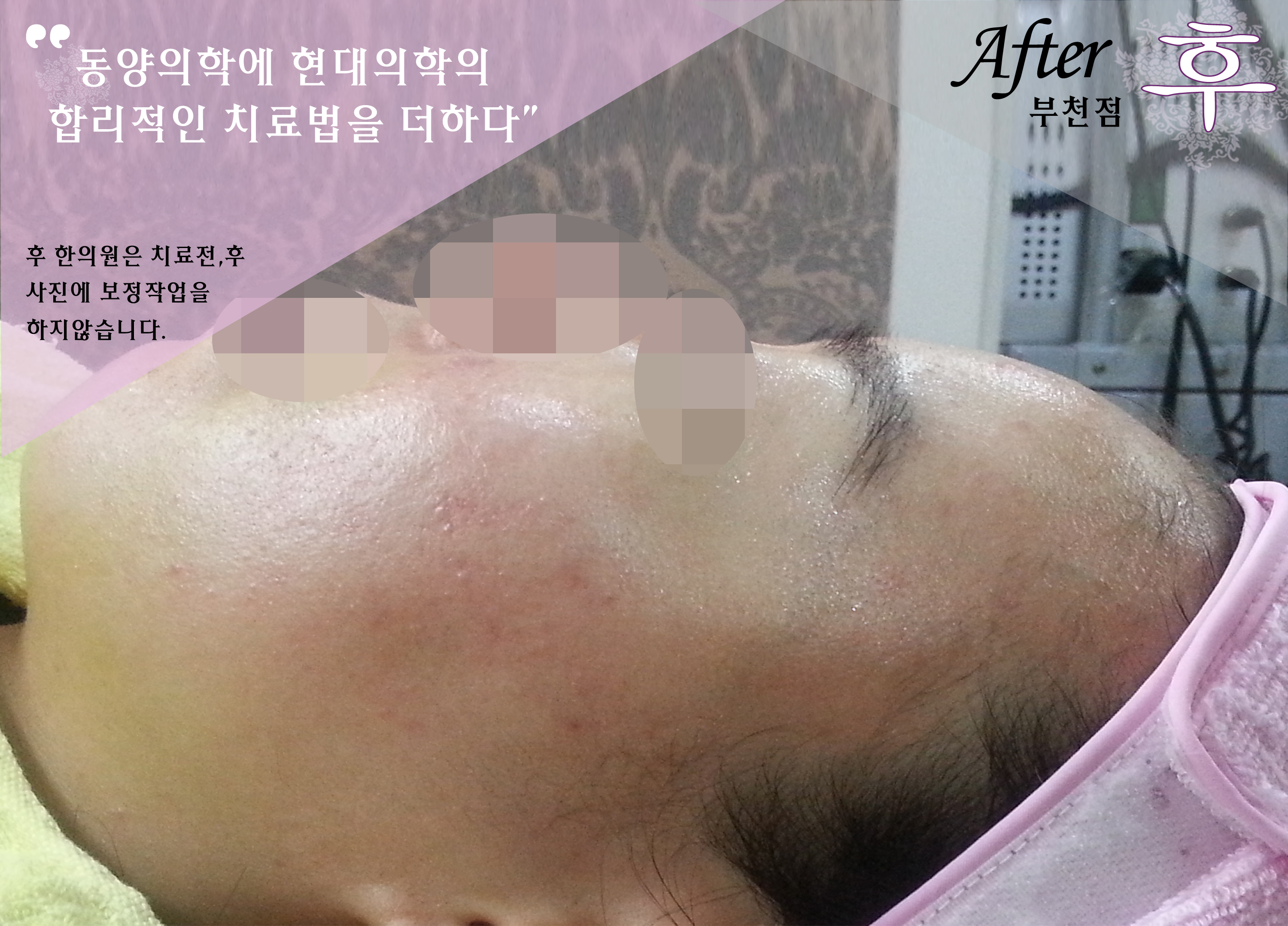 치료 후