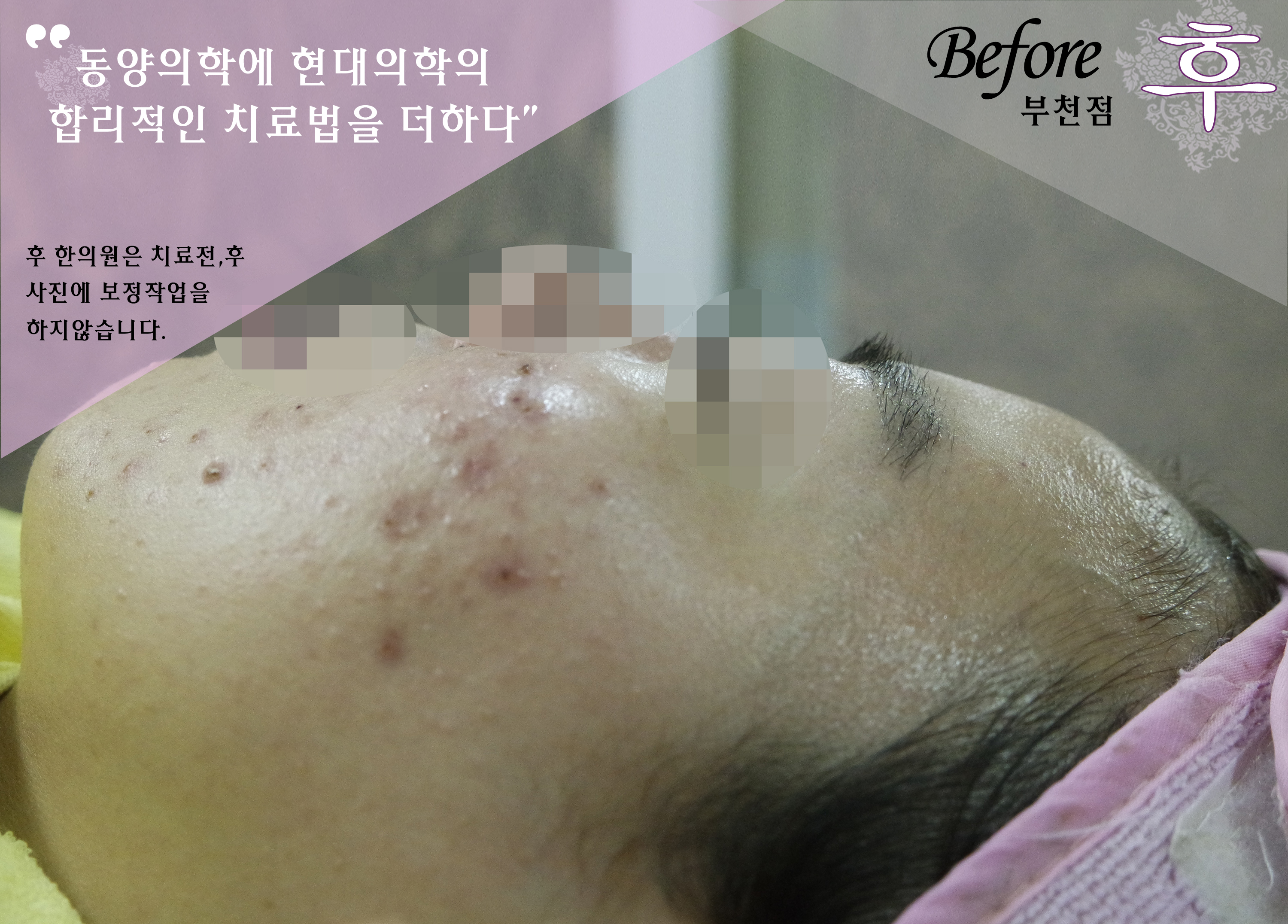 치료 전