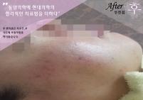치료 후