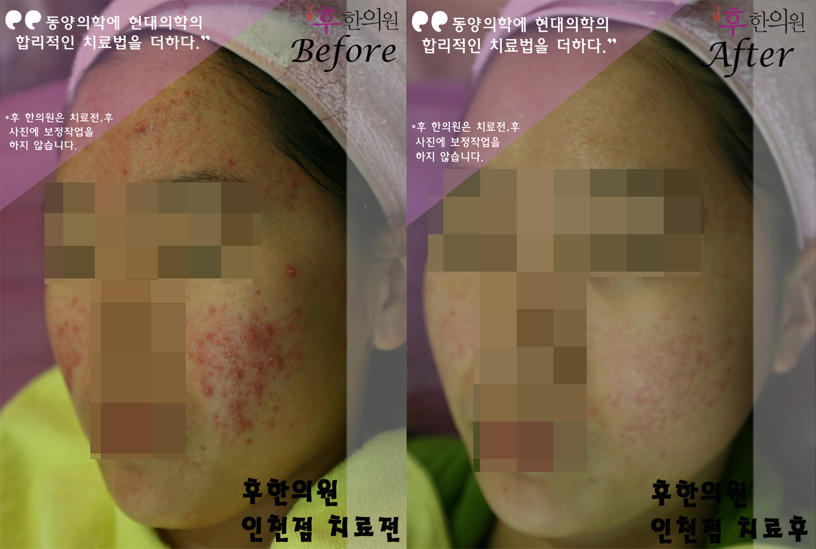 치료 후