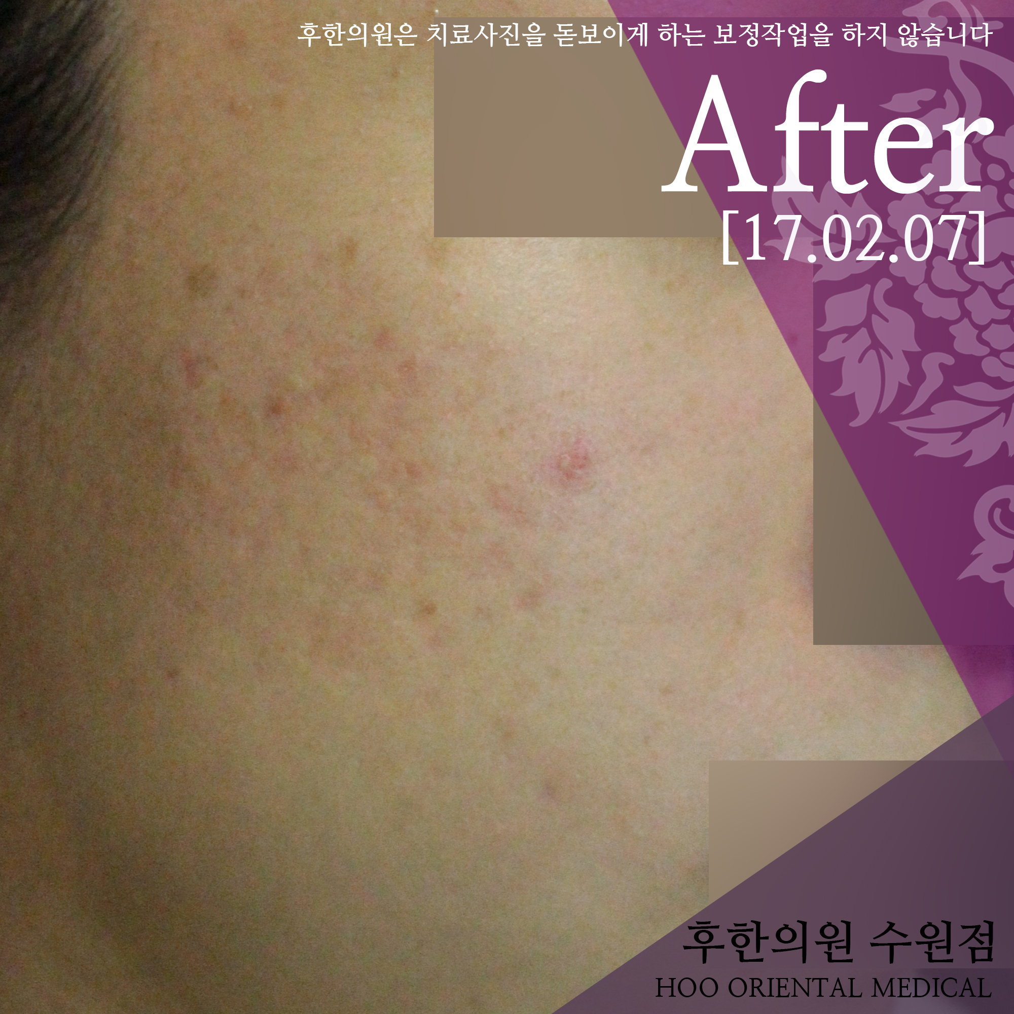 치료 후
