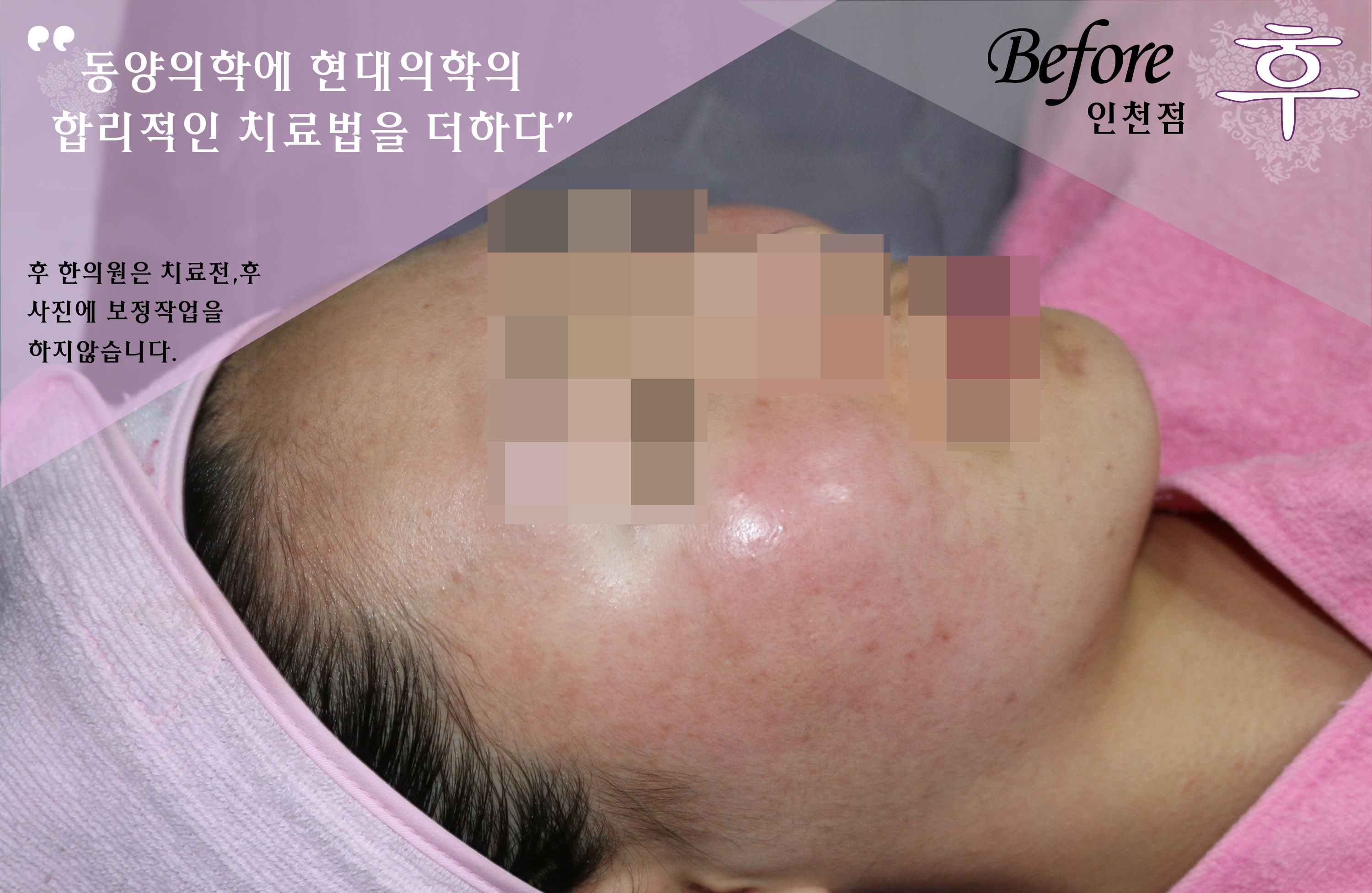 치료 전