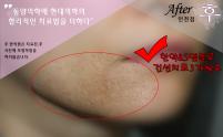 치료 후