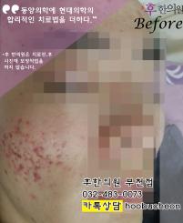 치료 전