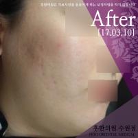 치료 후