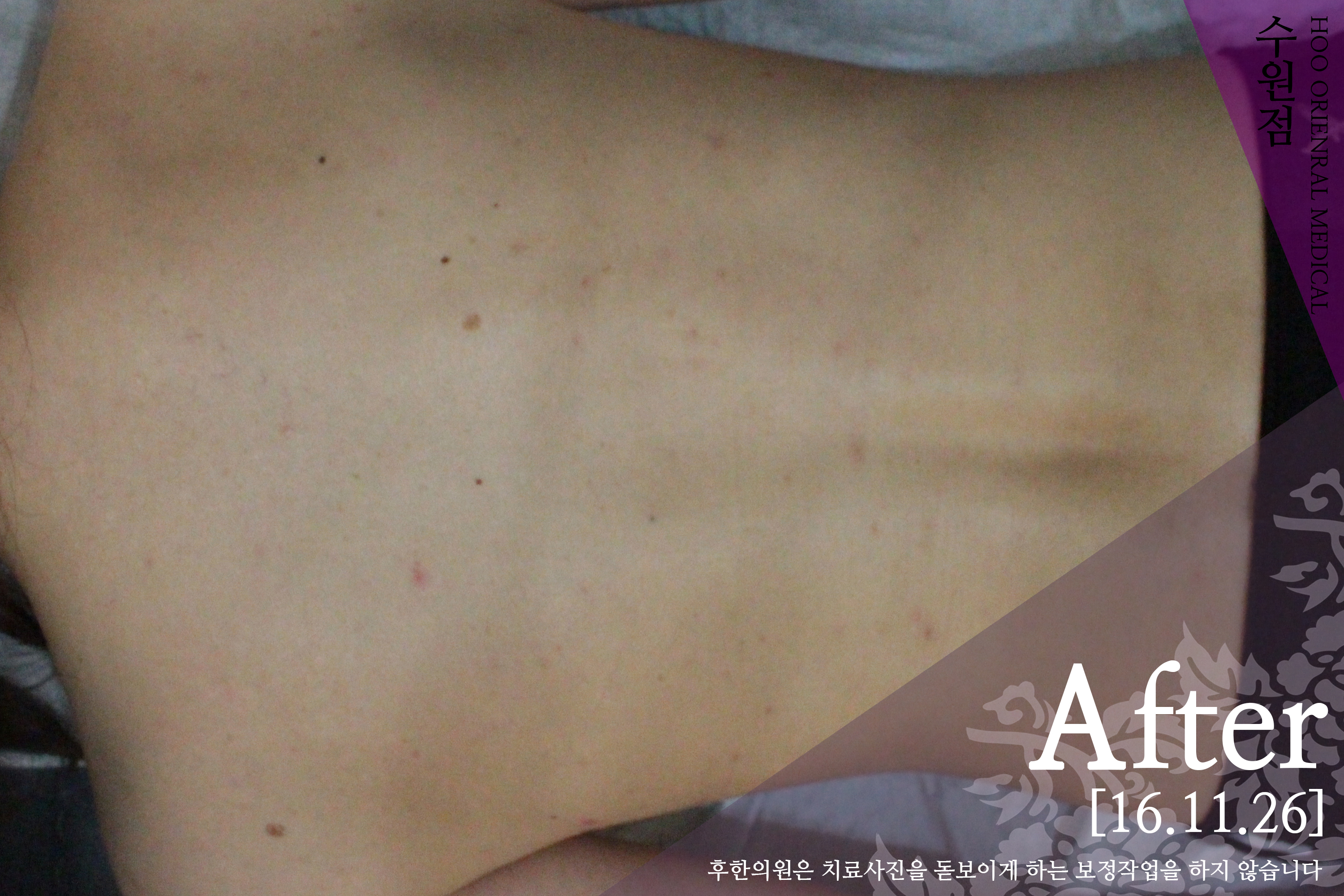 치료 후