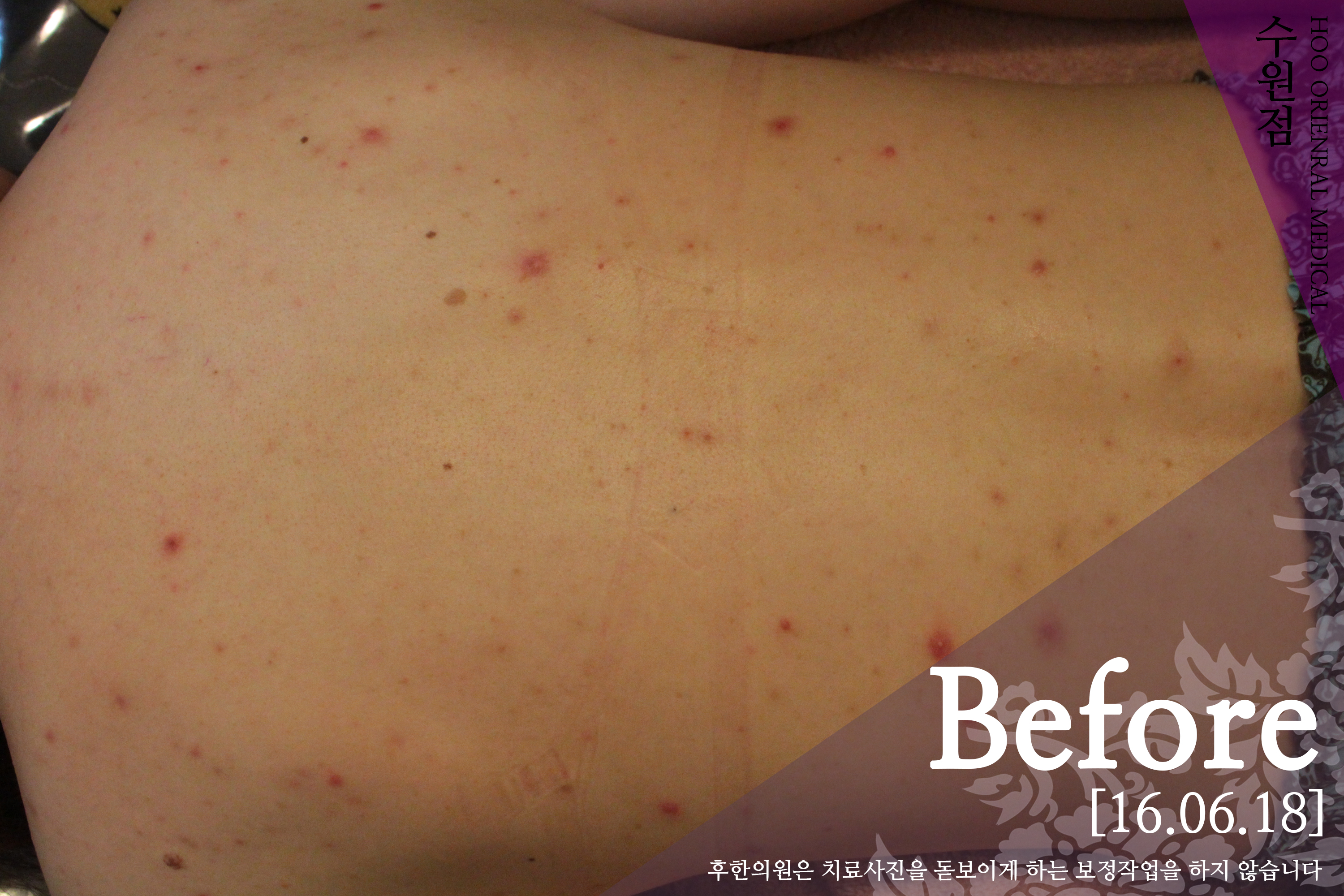 치료 전