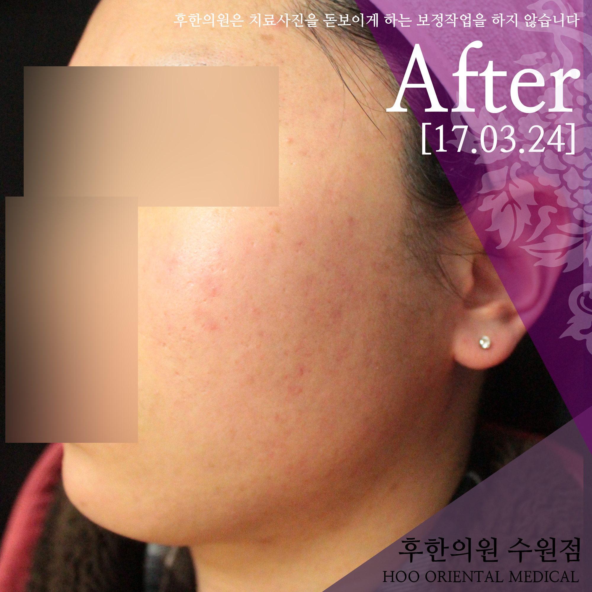 치료 후