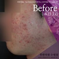 치료 전