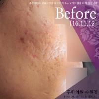 치료 전