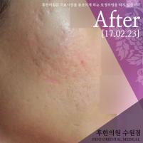 치료 후