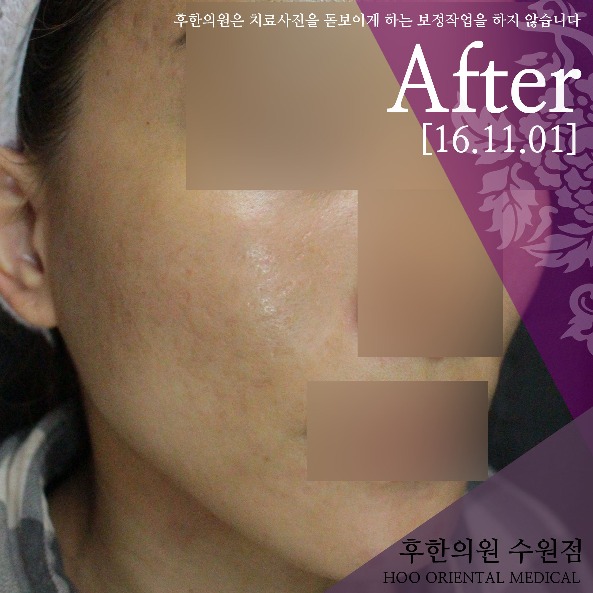 치료 후