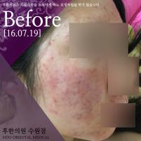 치료 전