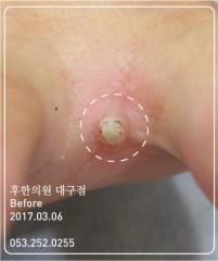 치료 전
