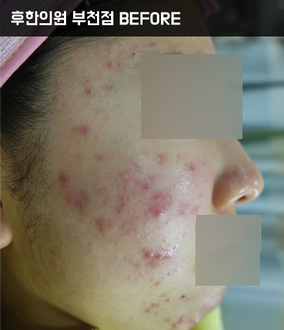 치료 전