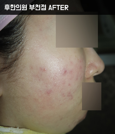 치료 후