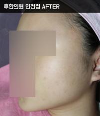 치료 후