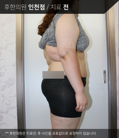 치료 전