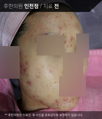 치료 전