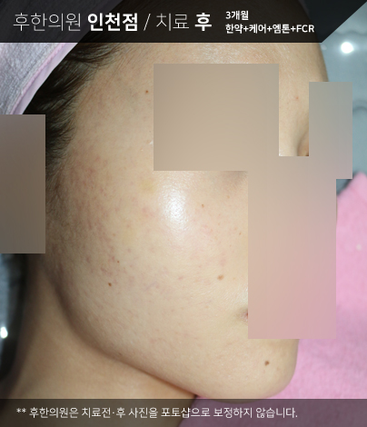 치료 후