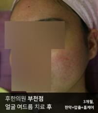 치료 후