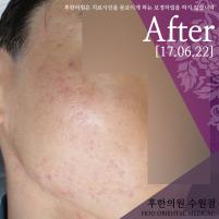 치료 후