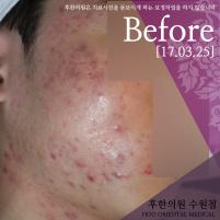 치료 전