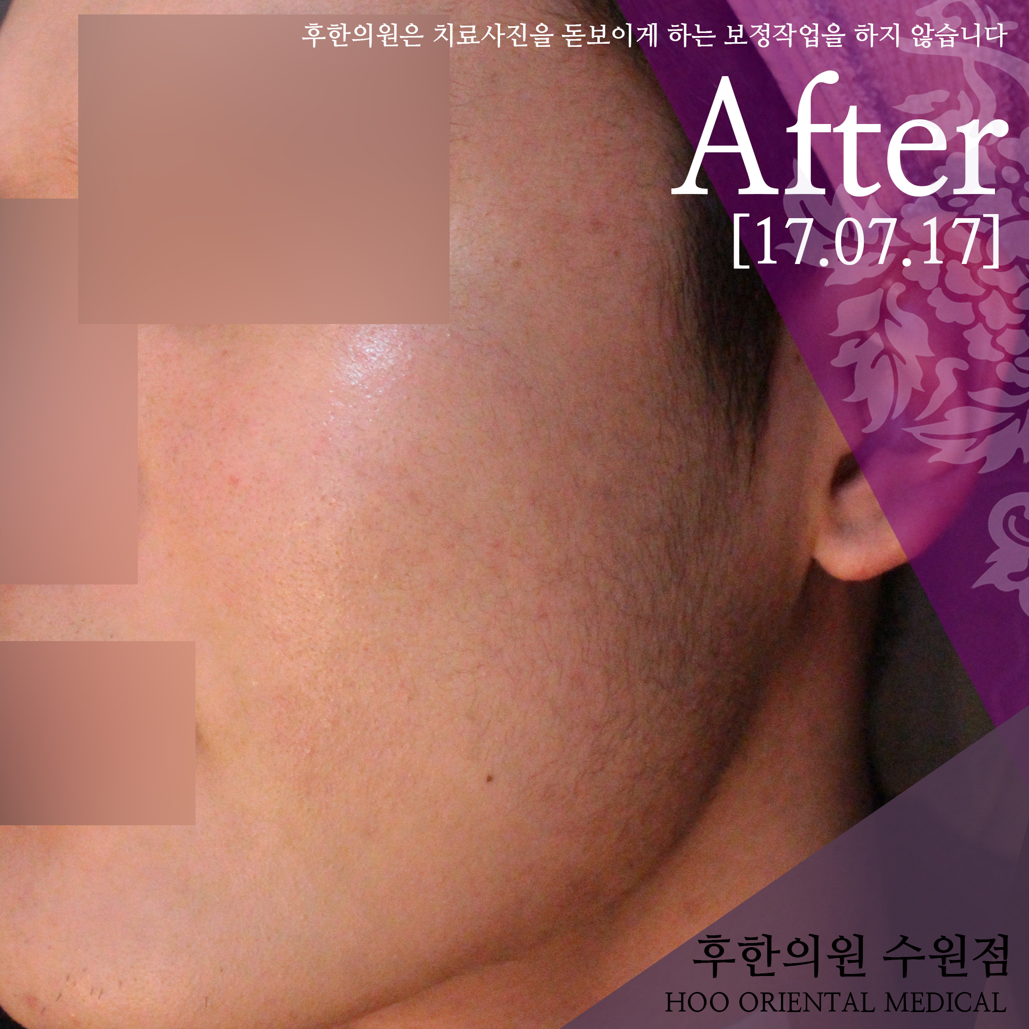 치료 후