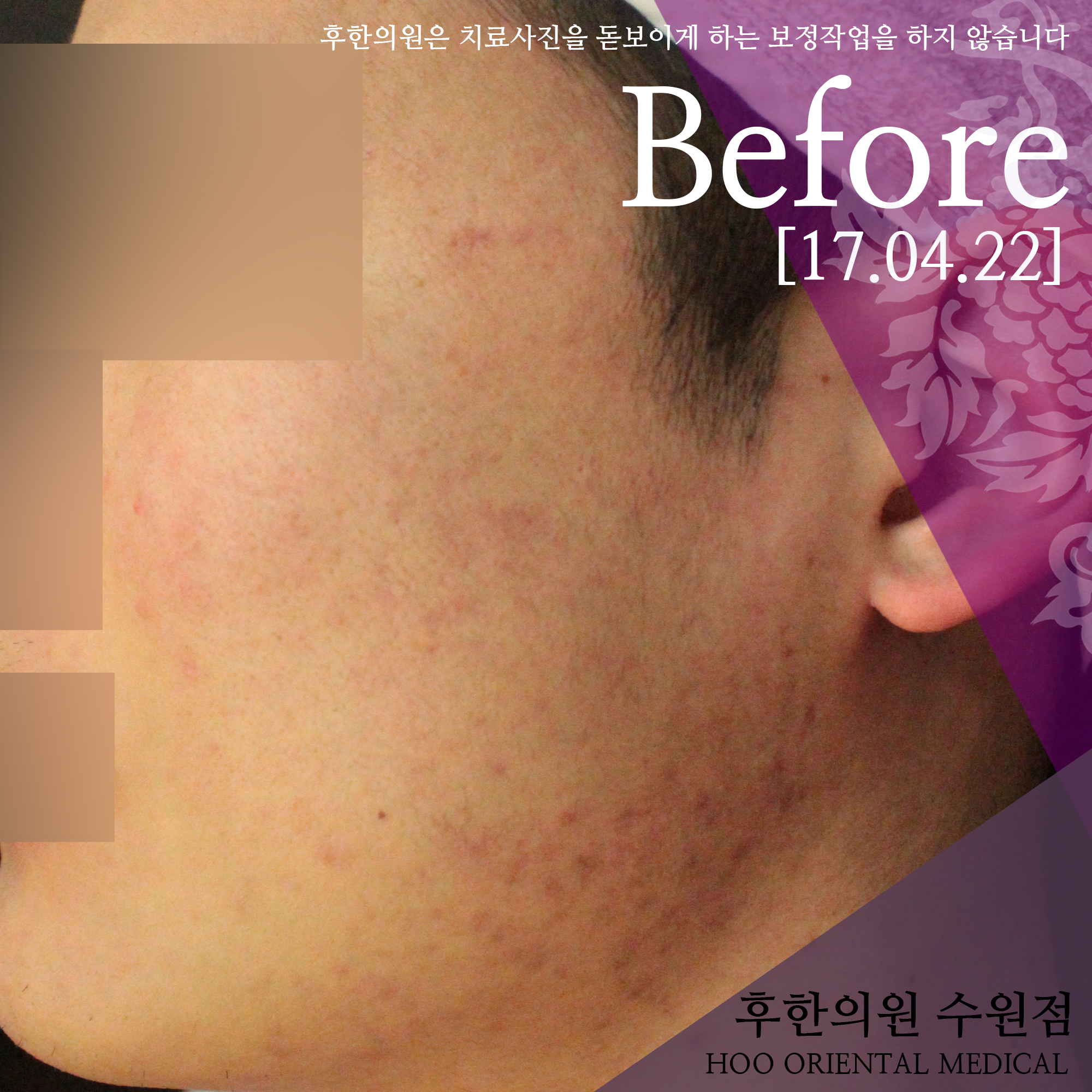 치료 전