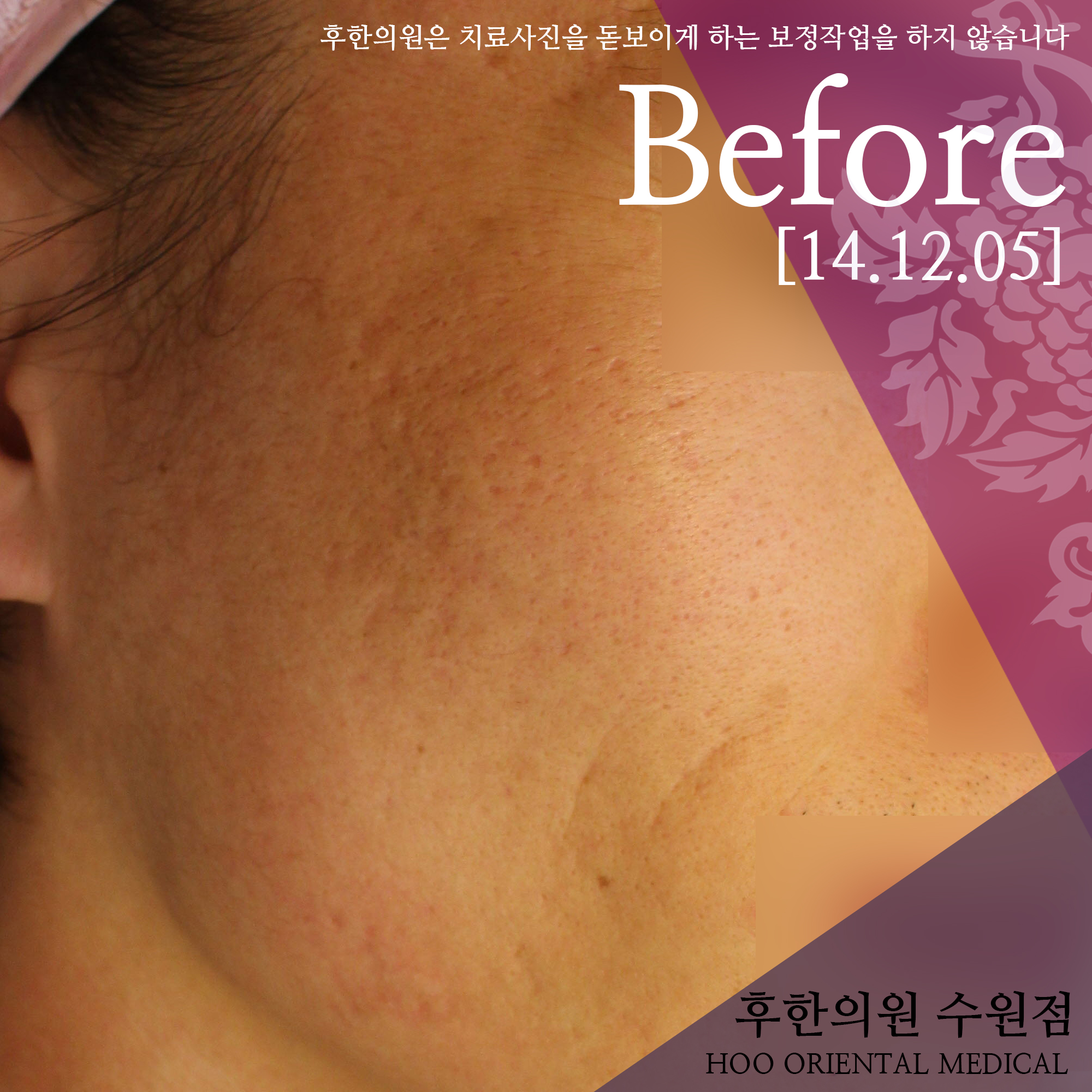 치료 전