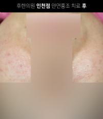 치료 후