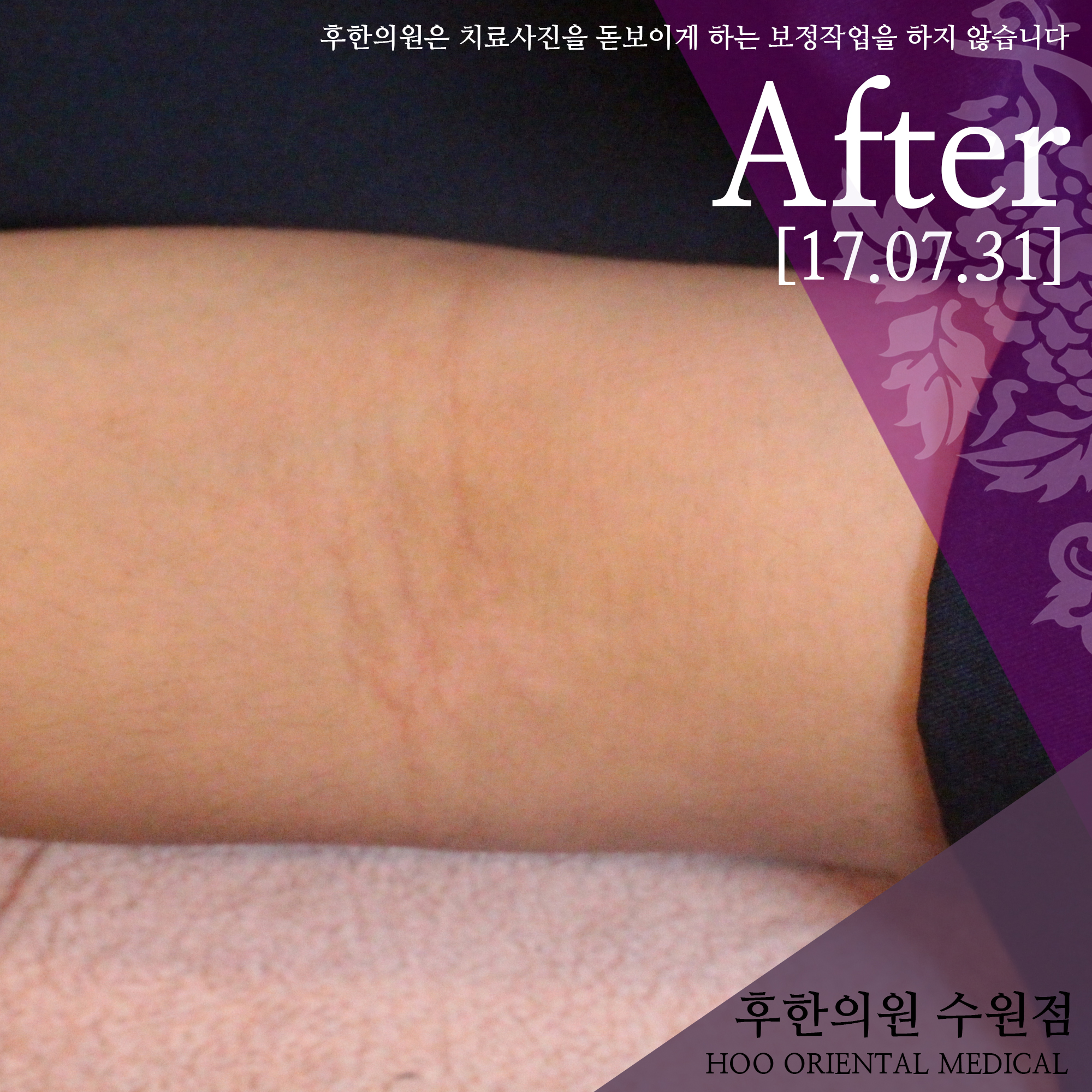 치료 후