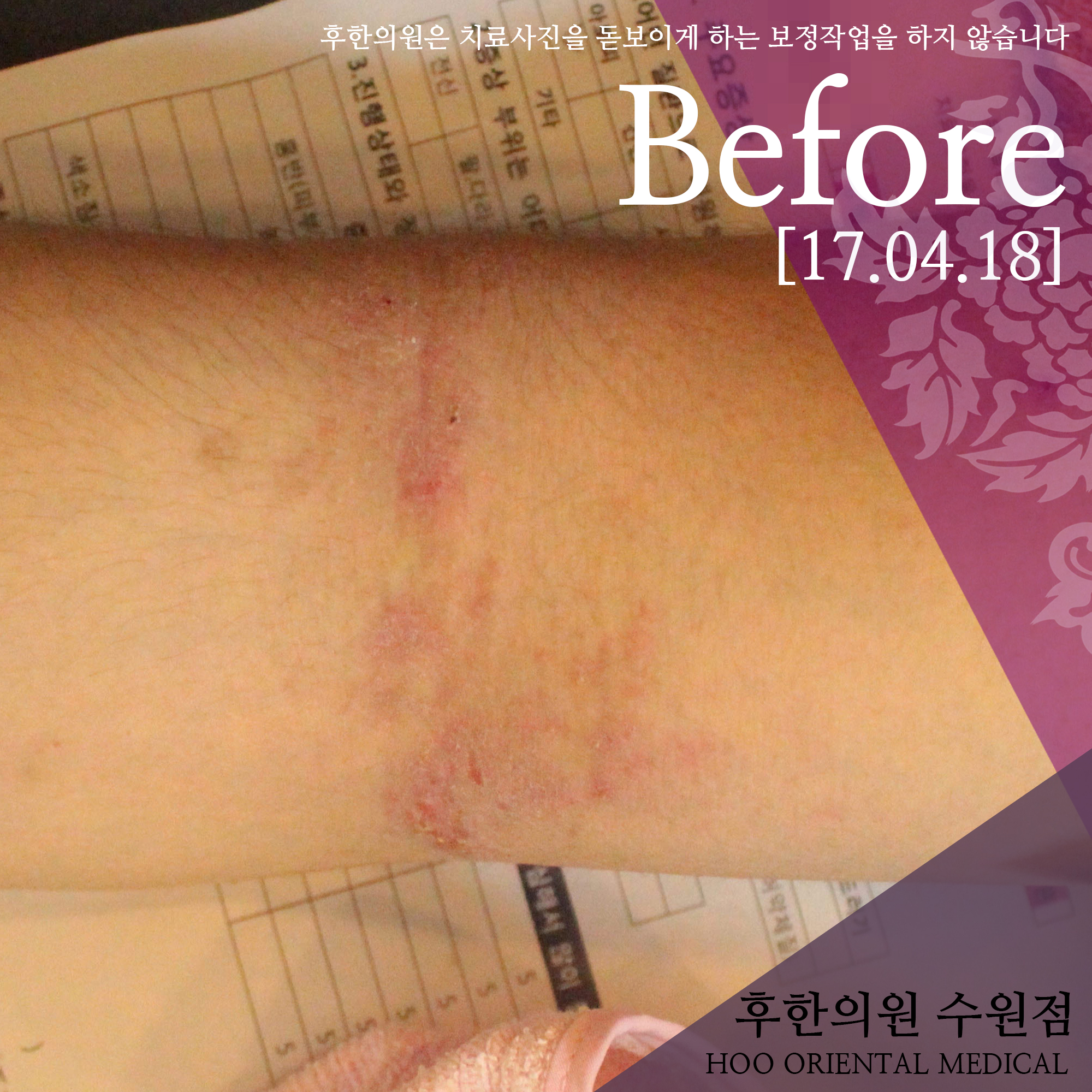 치료 전