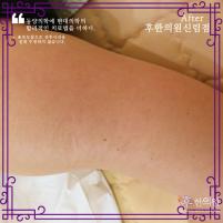 치료 후