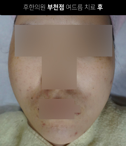 치료 후
