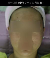 치료 후
