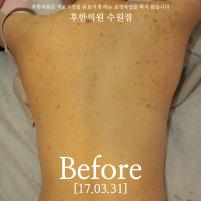 치료 전