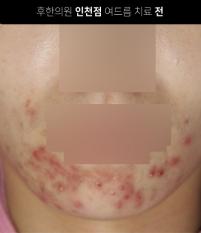 치료 전
