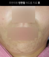 치료 후