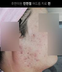 치료 전
