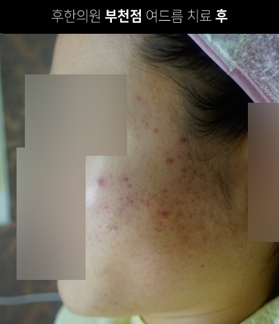 치료 후