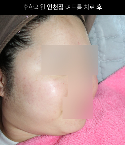 치료 후