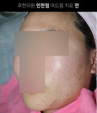 치료 전