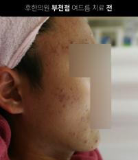 치료 전