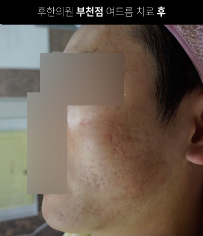 치료 후