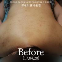 치료 전