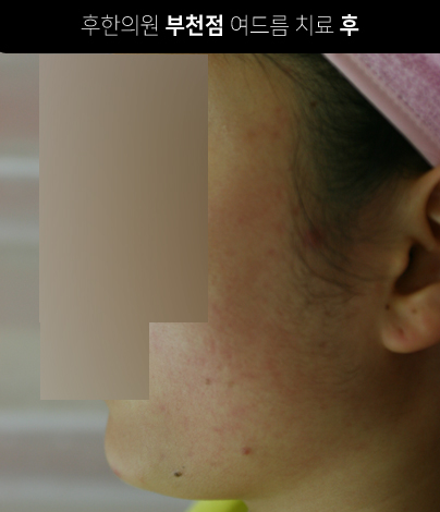 치료 후
